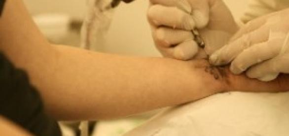 Rimozione dei tatuaggi Rimozione dei tatuaggi