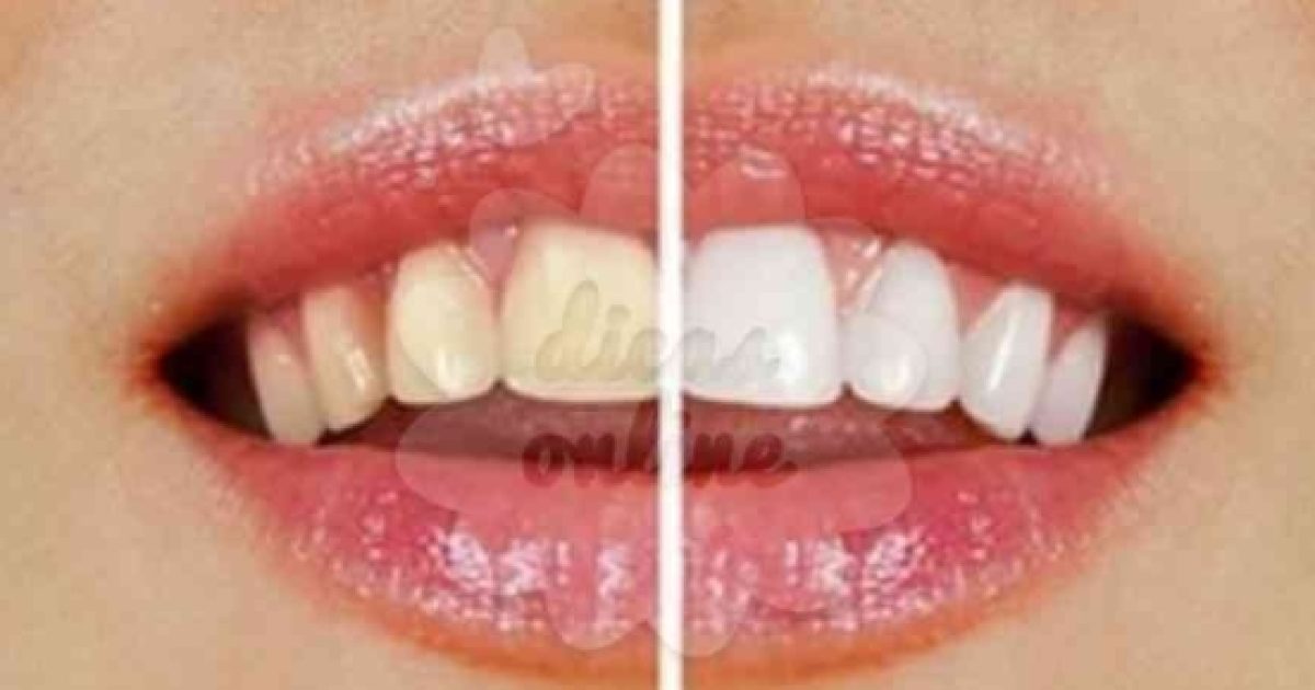 Dicas Para Clarear Seus Dentes Em Casa