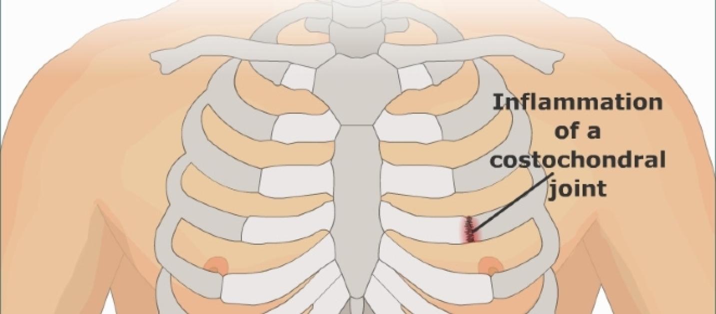 Costochondritis It's Not a Heart Attack