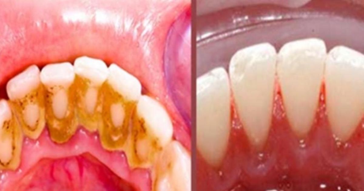 Confira Maneiras De Remover As Placas Bacterianas De Seus Dentes Em