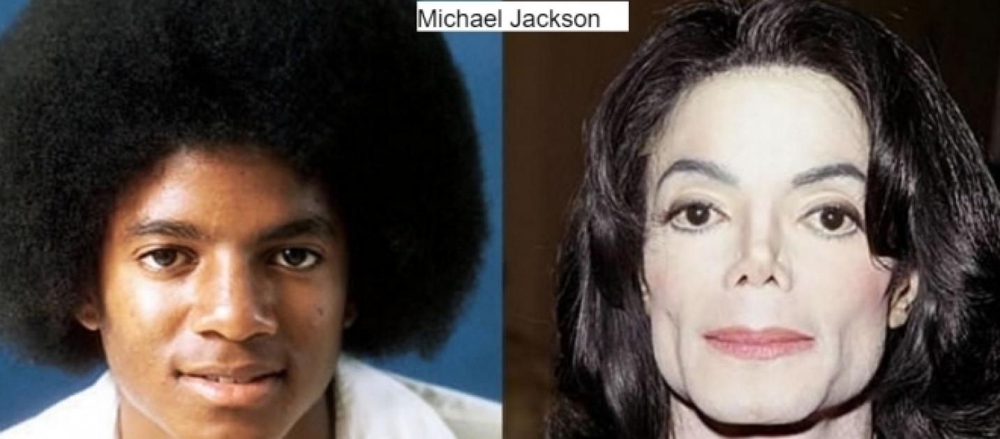 Antes e depois de famosos que ficaram irreconhecíveis após cirurgias