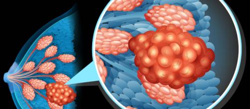 Tumore Al Seno Cinque Buone Abitudini Per Prevenirlo
