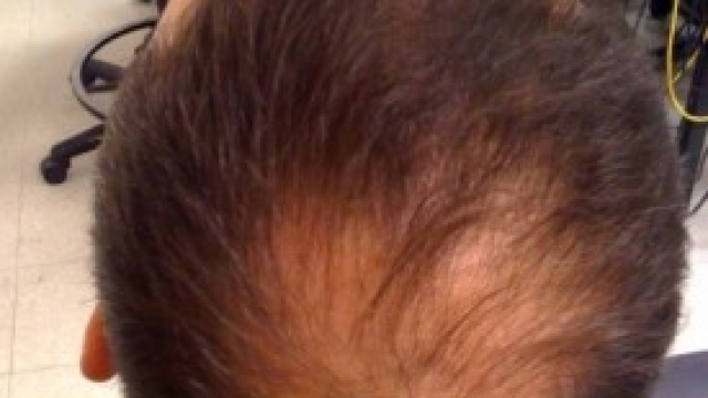 A breve il farmaco per contrastare l'alopecia