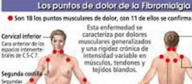 El mapa del dolor de la fibromialgia El mapa del dolor de la fibromialgia