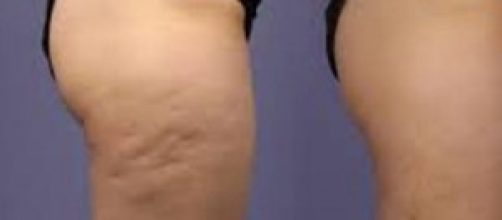 Sconfiggere la cellulite si può.