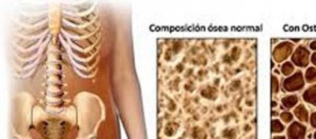 Comparación de hueso sano y hueso osteoporótico Comparación de hueso sano y hueso osteoporótico