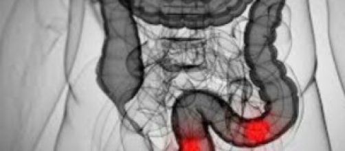 Esempio grafico di un tumore al colon e al retto