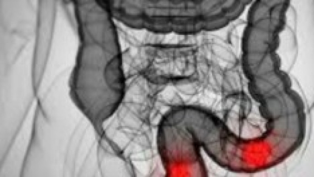 Esempio grafico di un tumore al colon e al retto