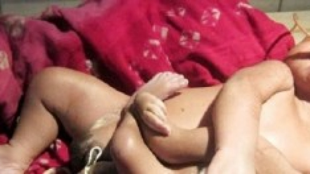 Il bambino nato con otto arti