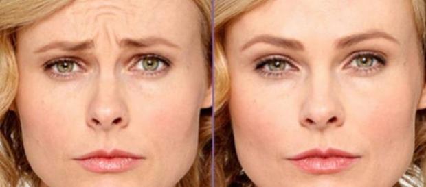Antes y después del uso del Botox Antes y después del uso del Botox