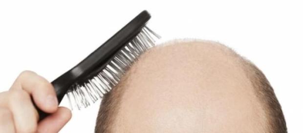 Calvície afecta essencialmente o sexo masculino Calvície afecta essencialmente o sexo masculino