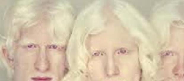 Albinos en Tanzania, condenados desde que nacen Albinos en Tanzania, condenados desde que nacen