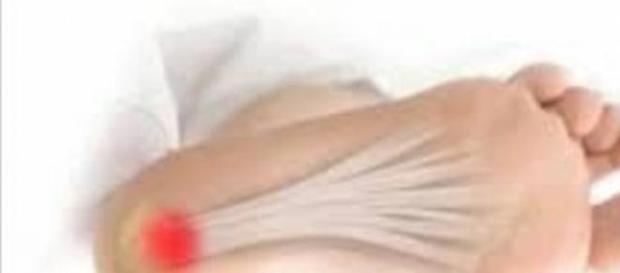 La fascitis plantar localizada en el pie La fascitis plantar localizada en el pie