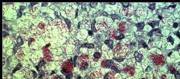 Una infección contra la que luchar Una infección contra la que luchar