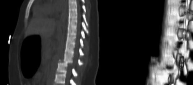 Sección medular parcial que acaba con paraplejia Sección medular parcial que acaba con paraplejia