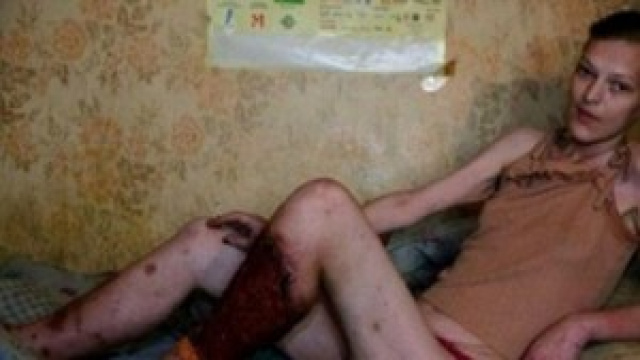 Krokodil, la droga che uccide