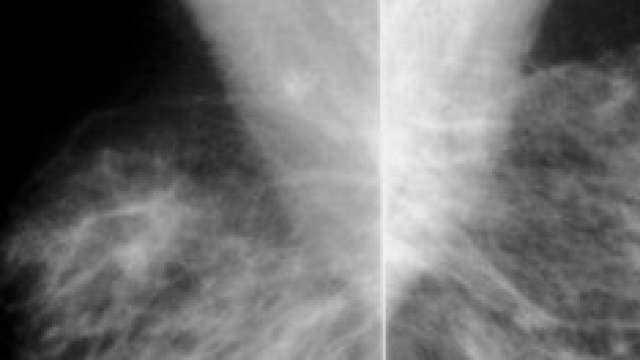 proiezione obliqua medio-laterale