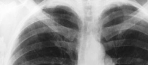 Una radiografia dei polmoni