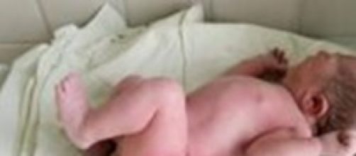 Uno dei due gemelli nati a 24 giorni di distanza