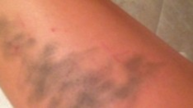 I lividi dopo la rissa con Claudia Galanti.