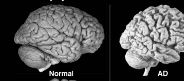 Comparación entre un cerebro sano y con Alzheimer Comparación entre un cerebro sano y con Alzheimer