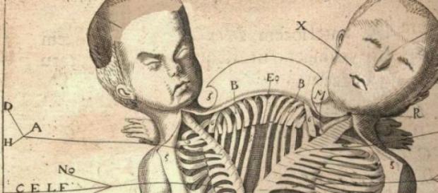Desenho esquemático de gêmeos siameses Desenho esquemático de gêmeos siameses