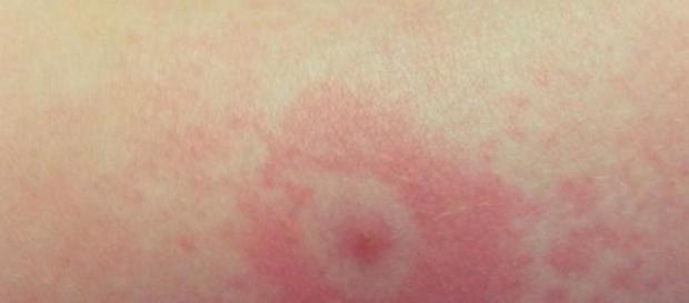Eritrem migrator,semnul distinctiv al Borreliozei Eritrem migrator,semnul distinctiv al Borreliozei