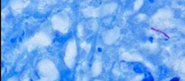 La tuberculosis, una grave enfermedad La tuberculosis, una grave enfermedad