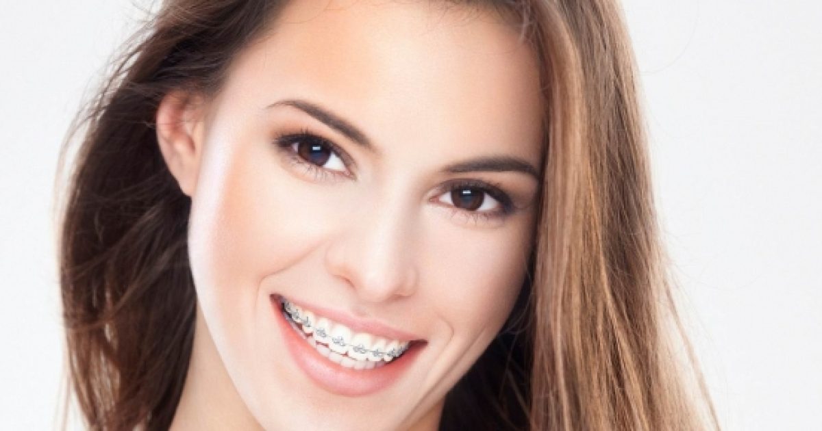 Braces for adolescents and young people fashion or necessity?