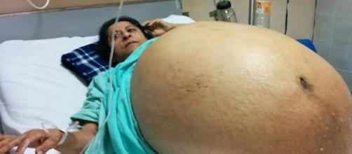Tumor de 60 kg é retirado de mulher mexicana