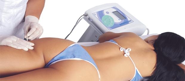 Veja os efeitos colaterais da carboxiterapia Veja os efeitos colaterais da carboxiterapia