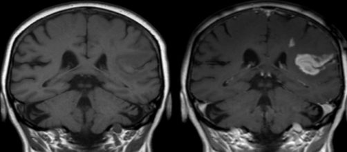 Radiografía de derrame cerebral o ictus