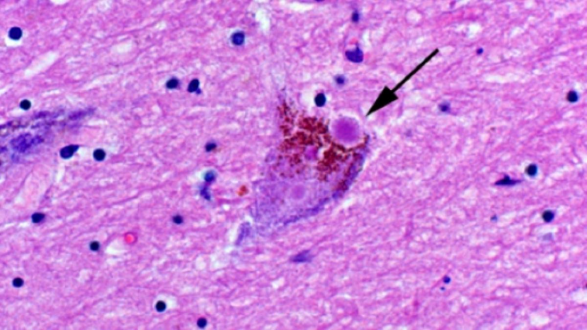 Cosa Sono I Corpi Di Lewy Demenza A Corpi Di Lewy - ishcknight