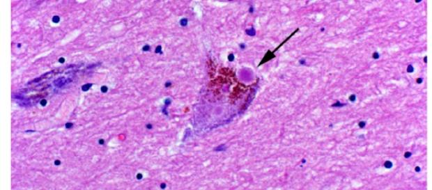Un corpo di Lewy (freccia) in un neurone Un corpo di Lewy (freccia) in un neurone