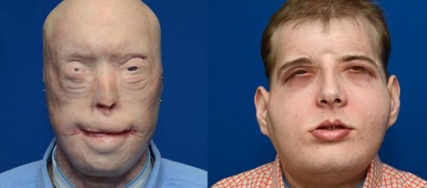 El antes y el después de Patrick Hardison El antes y el después de Patrick Hardison
