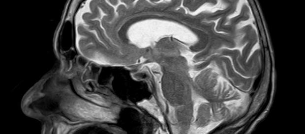 MRI scan. Pixabay commons. No attrition MRI scan. Pixabay commons. No attrition