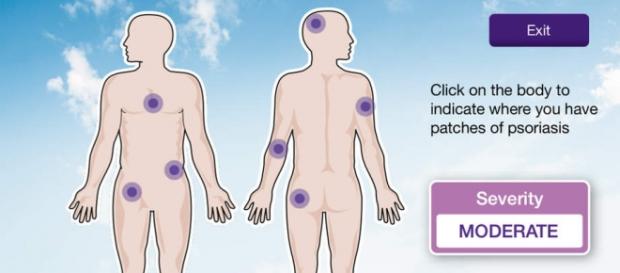 App Psoriasis 360, laboratorios Janssen App Psoriasis 360, laboratorios Janssen