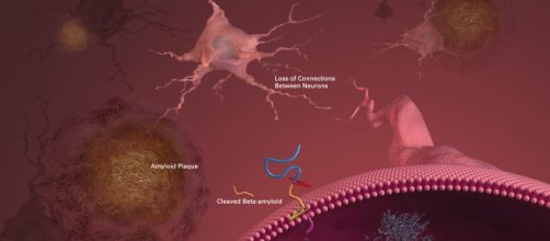 Placche amiloidi e perdita di sinapsi