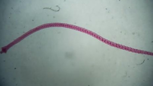 Scoperta connessione tra verme e tumore