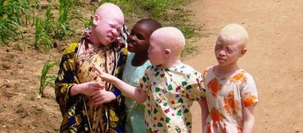 Albinos da Tanzânia são discriminados Albinos da Tanzânia são discriminados