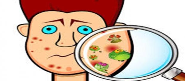 como acabar com as espinhas (acne) como acabar com as espinhas (acne)