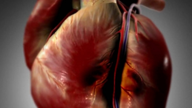I'infarto nel miocardio in un'immagine in 3D
