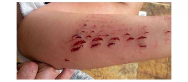 Imagen del brazo de la víctima tras el ataque Imagen del brazo de la víctima tras el ataque