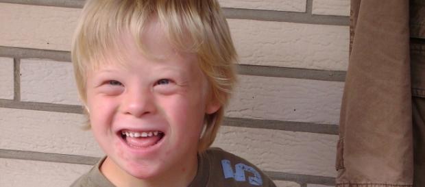 Un bambino con sindrome di Down Un bambino con sindrome di Down