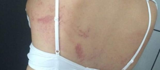 Fotografia dos hematomas da filha de Ribeiro. Fotografia dos hematomas da filha de Ribeiro.