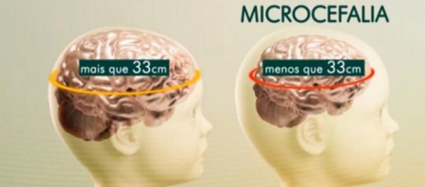 Primeiro caso de microcefalia em São Paulo Primeiro caso de microcefalia em São Paulo
