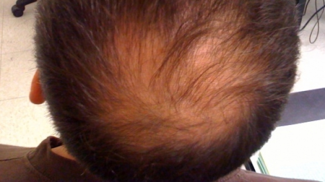 Alopecia androgenetica in stadio avanzato