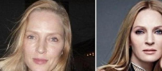 Uma, antes y después de su operación estética Uma, antes y después de su operación estética