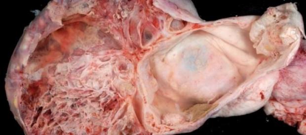 La THM aumenta el riesgo de cáncer de ovario La THM aumenta el riesgo de cáncer de ovario