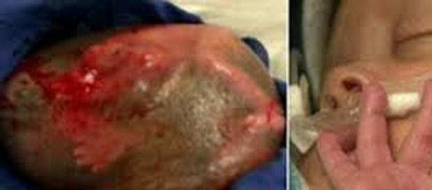 Un bebe nace en el saco amniótico en intacto Un bebe nace en el saco amniótico en intacto